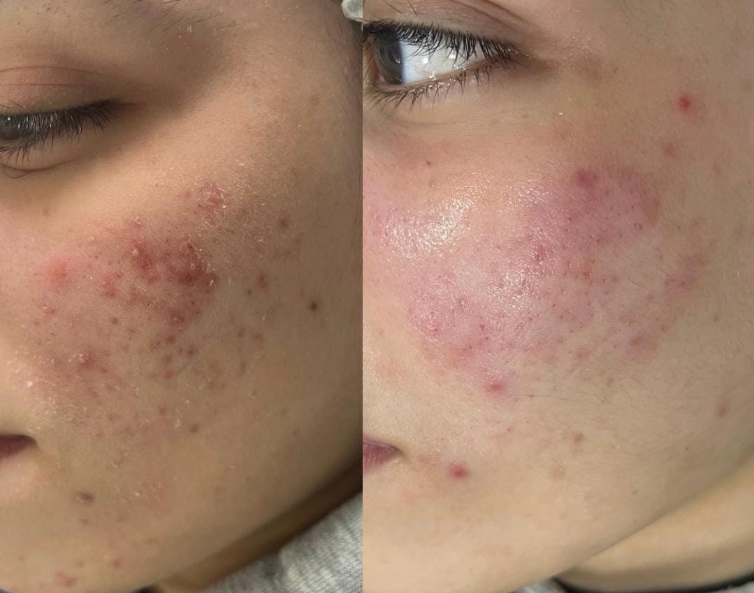 colocar na parte de limpeza de pele no site