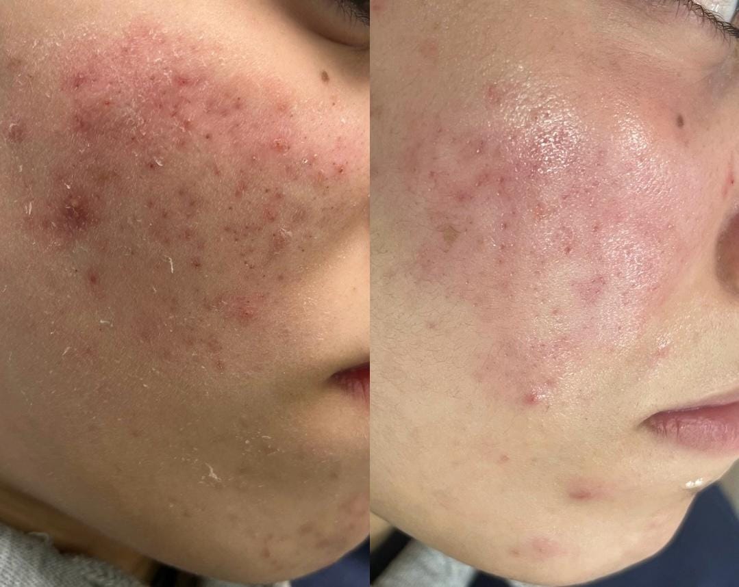 colocar no site em limpeza de pele