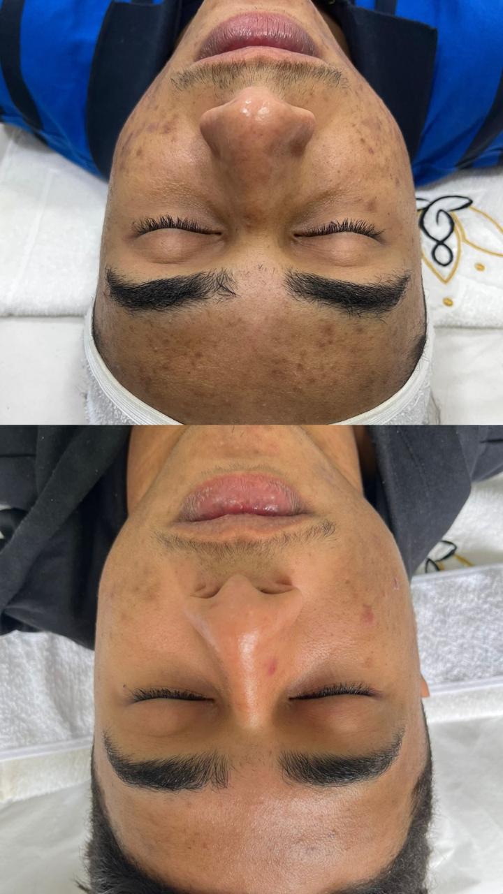 foto da cama de peeling e microagulhamento