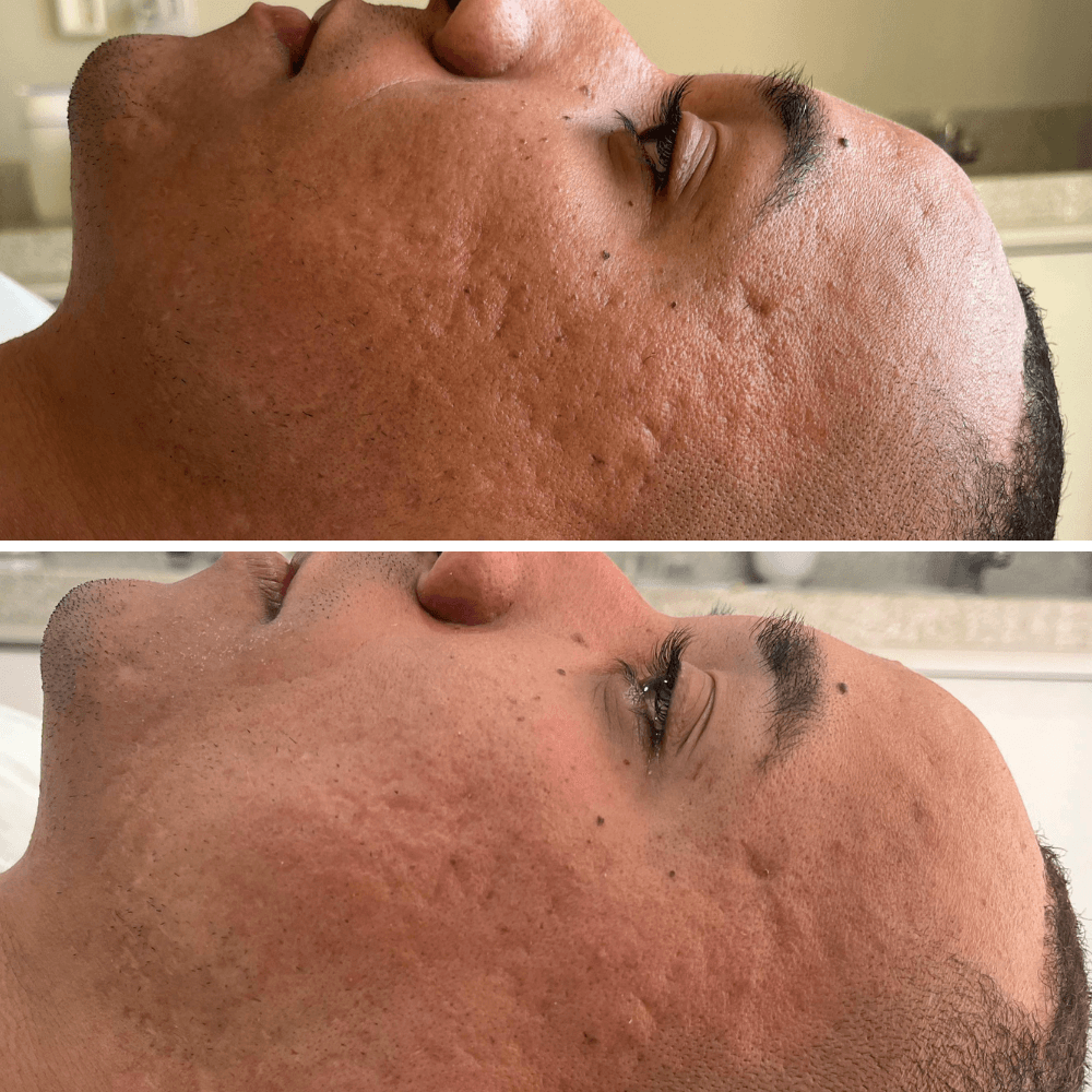 foto da cama de peeling e microagulhamento