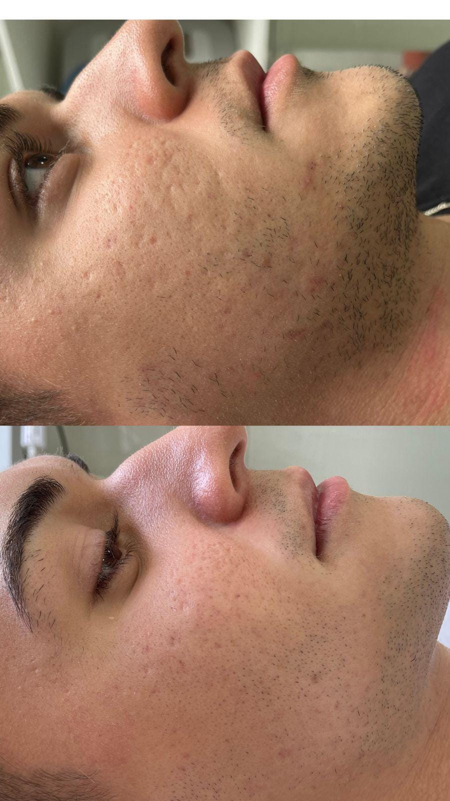 foto da cama de peeling e microagulhamento (1)