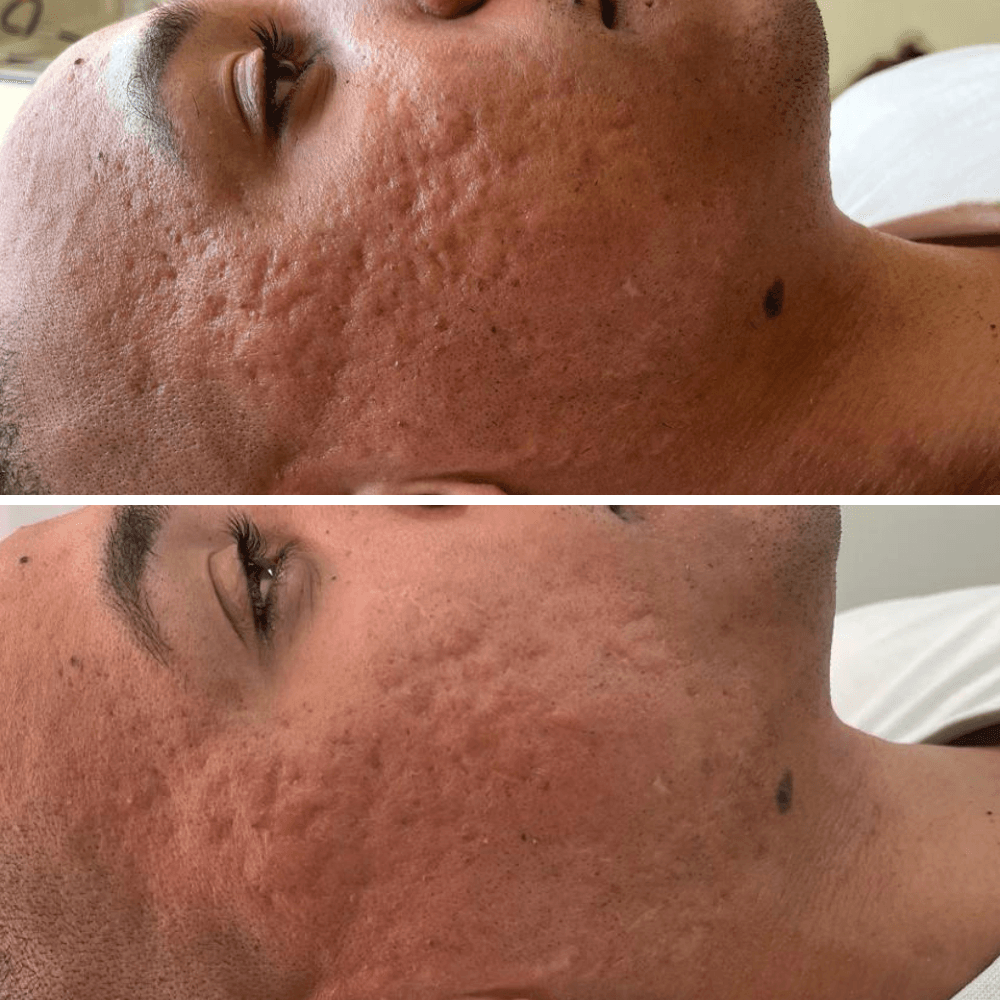 foto da cama de peeling e microagulhamento (1)