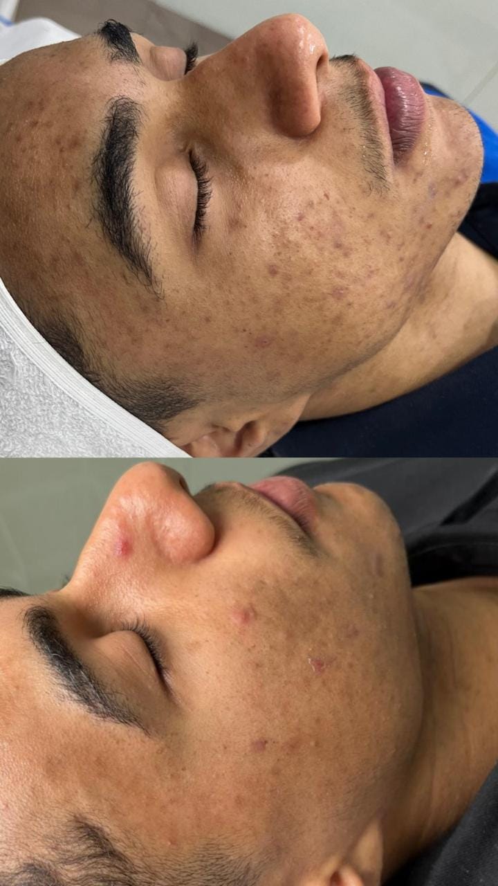 foto da cama de peeling e microagulhamento (2)