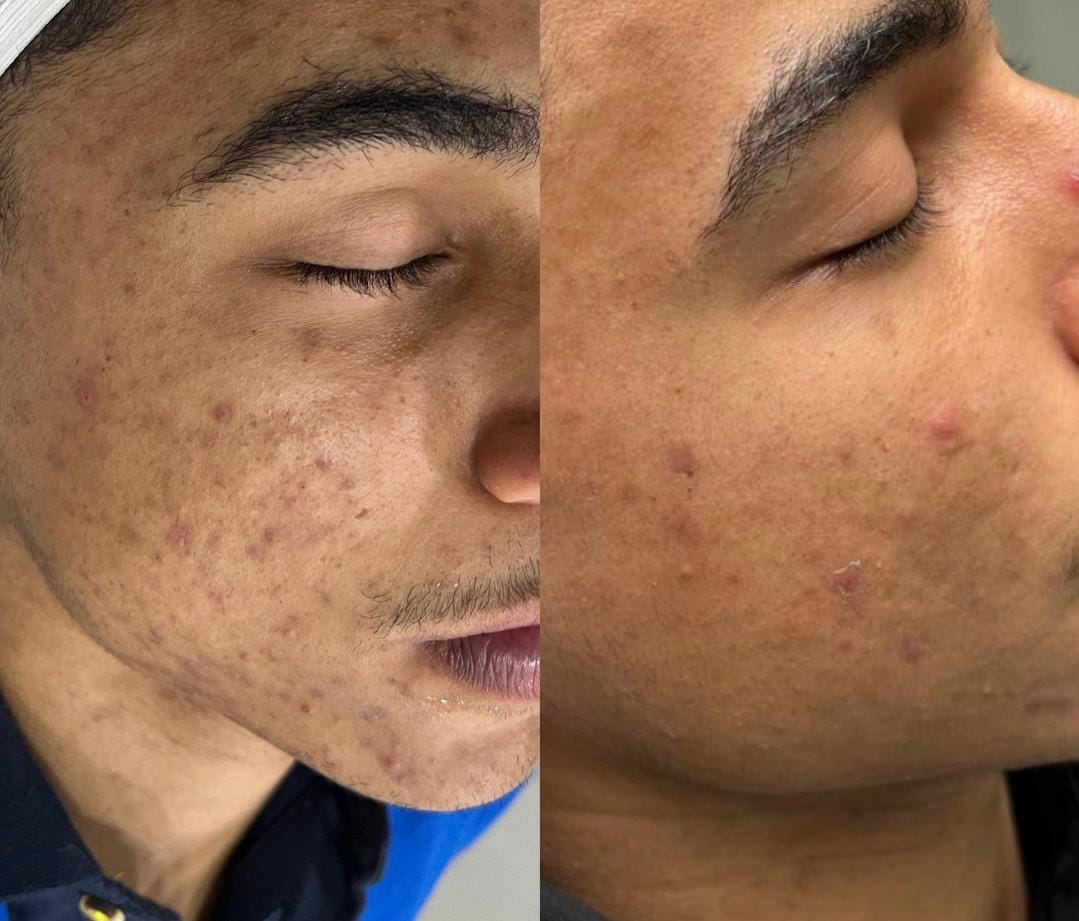 foto da cama de peeling e microagulhamento (3)