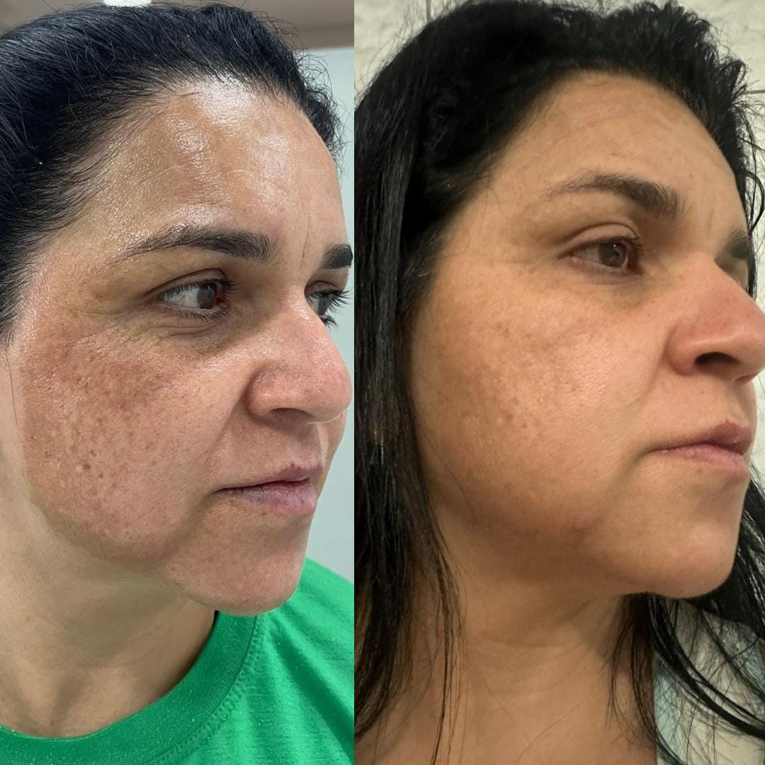 foto da cama de peeling e microagulhamento (4)