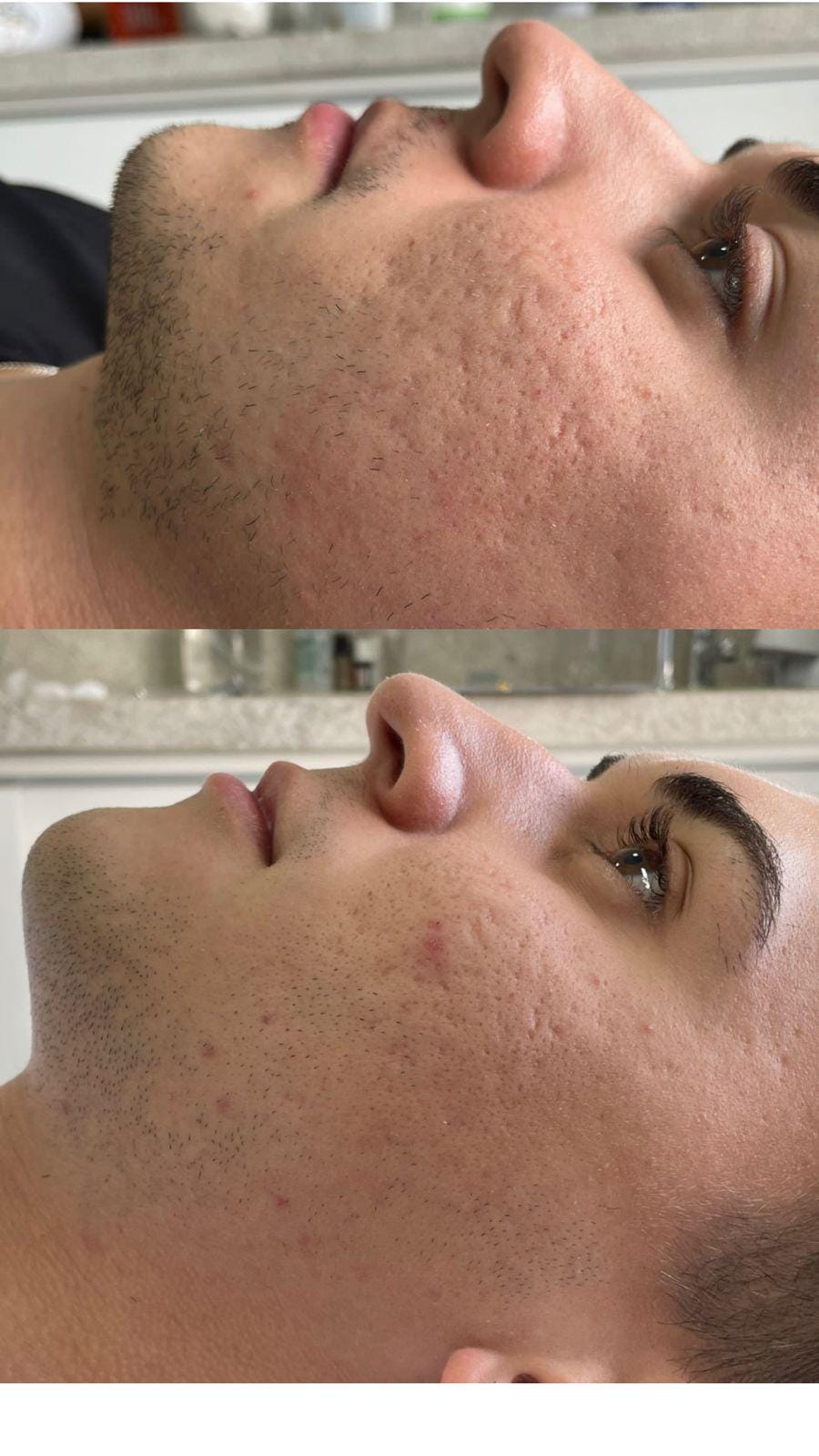 foto da cama de peeling e microagulhamento (5)