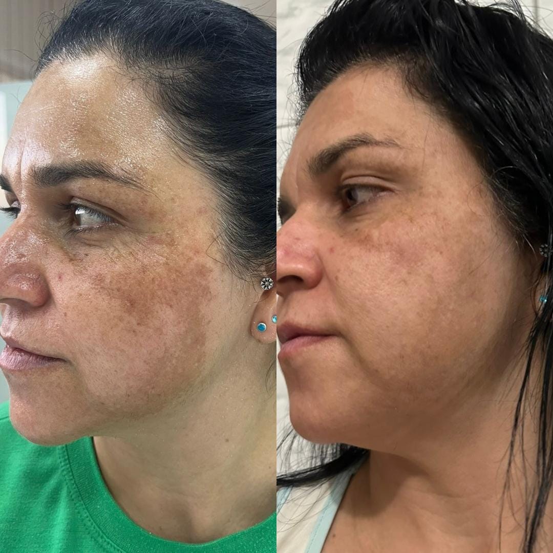 foto da cama de peeling e microagulhamento (6)