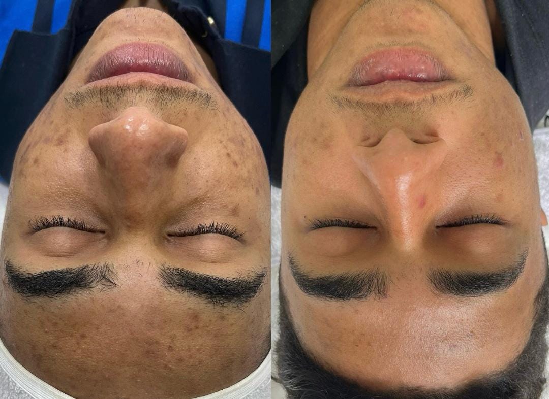 foto da cama de peeling e microagulhamento (7)