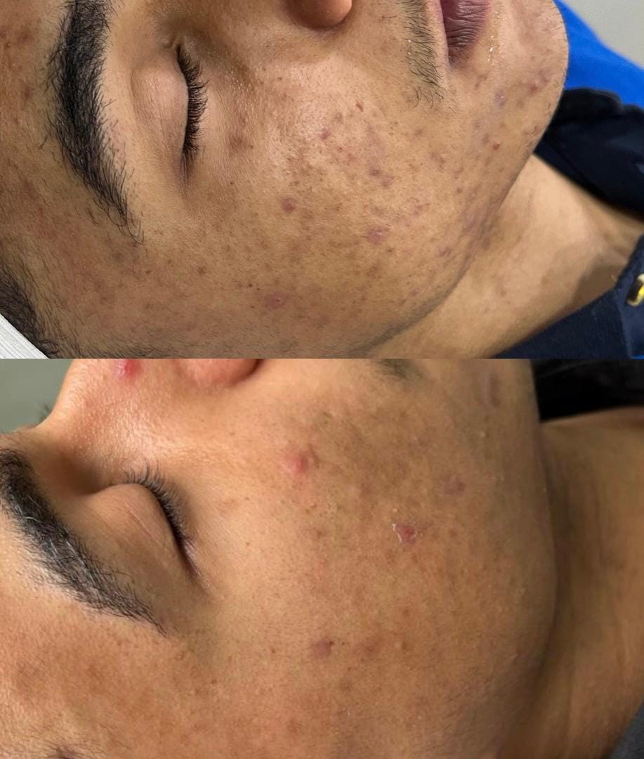 foto da cama de peeling e microagulhamento (8)